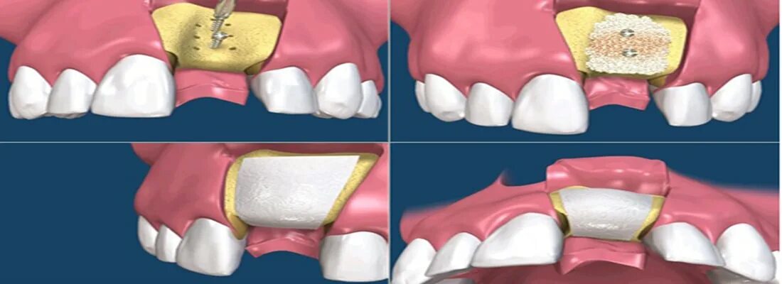 После костной пластики фото Костная пластика при имплантации зубов: хирургия и осложнения.