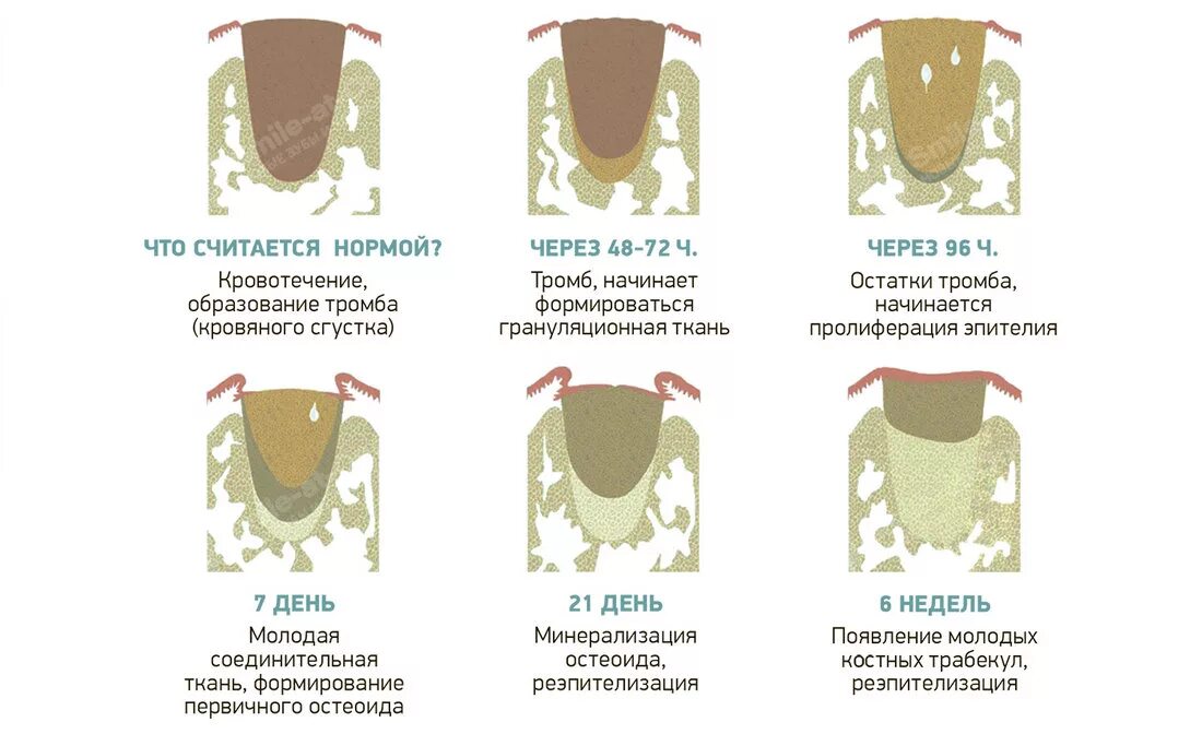 После удаления зуба фото по дням Как заживают зубы после удаления - Стоматология Северное Бутово Делия только кач