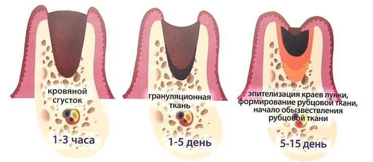 После удаления зуба фото по дням Восстановление после удаления зуба - Пушкино: этапы, варианты