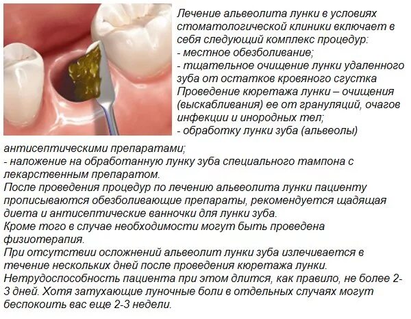 После удаления зуба фото по дням Картинки МОЖНО ЛИ ПИТЬ ПРИ УДАЛЕНИИ ЗУБА