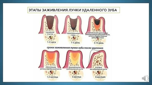 После удаления зуба фото по дням Про нашу регенерацию / Хабр