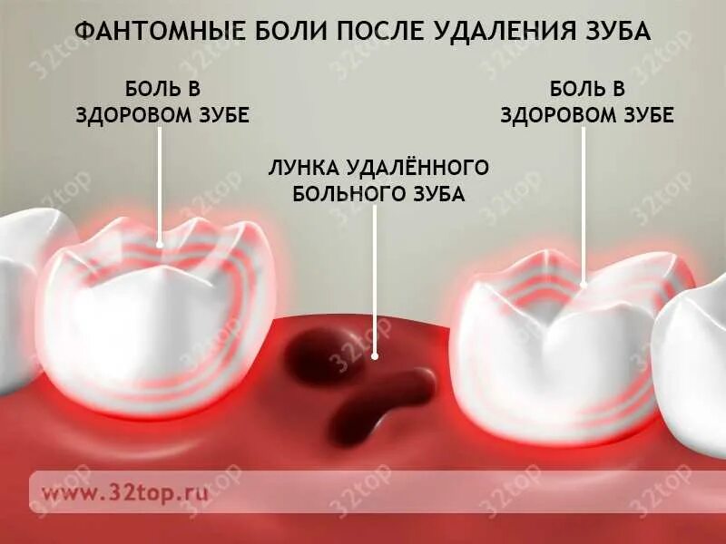 После удаления зуба фото по дням Через сколько убрать вату после удаления зуба