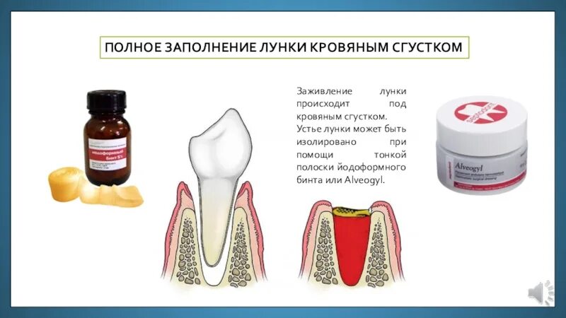 После удаления зуба фото по дням Где удалить зуб тюмень - найдено 90 картинок