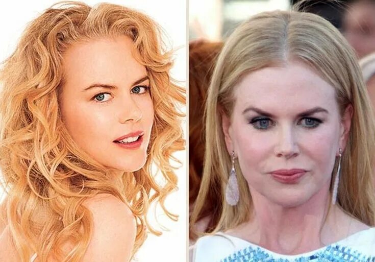 Последние фото николь кидман после пластики Nicole Kidman plastic surgery for puffy look Cirugia plástica, Nicole kidman, Ci