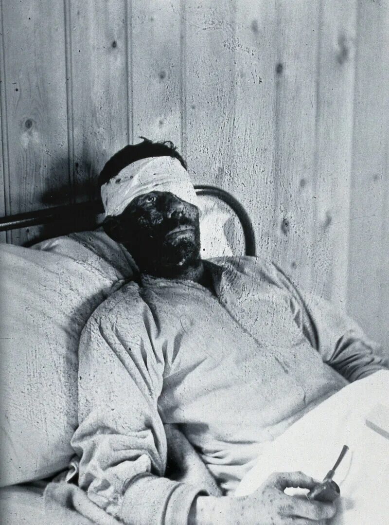 Последняя стадия чумы фото Gloucester smallpox epidemic, 1896: William Allen as a smallpox patient. Photogr