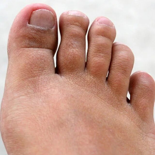 Последняя стадия гангрены ноги фото Morton;s Neuroma causes toe pain and burning. podiatry ideas Toenail fungus lase