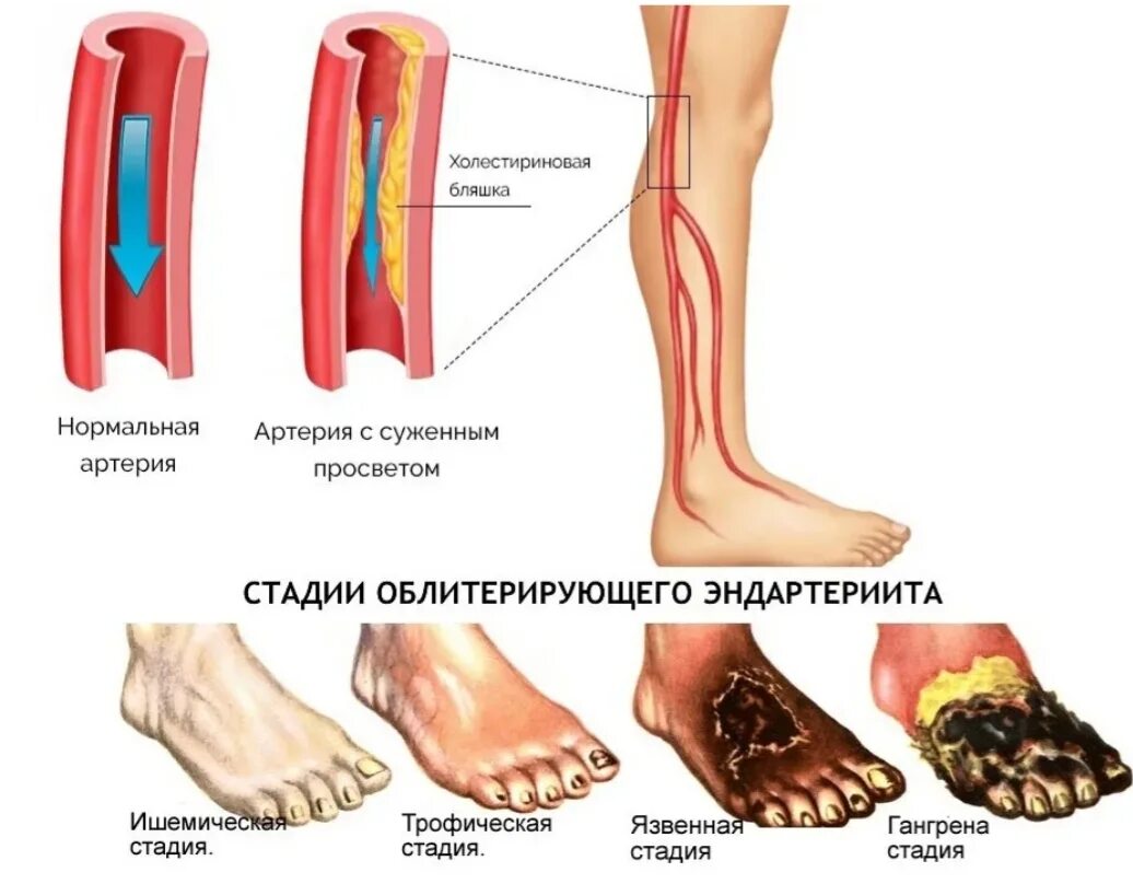 Последняя стадия гангрены ноги фото Лечение эндартериита в Хабаровске - Медикъ