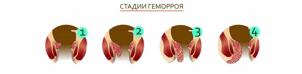 Стадии наружного геморроя схема