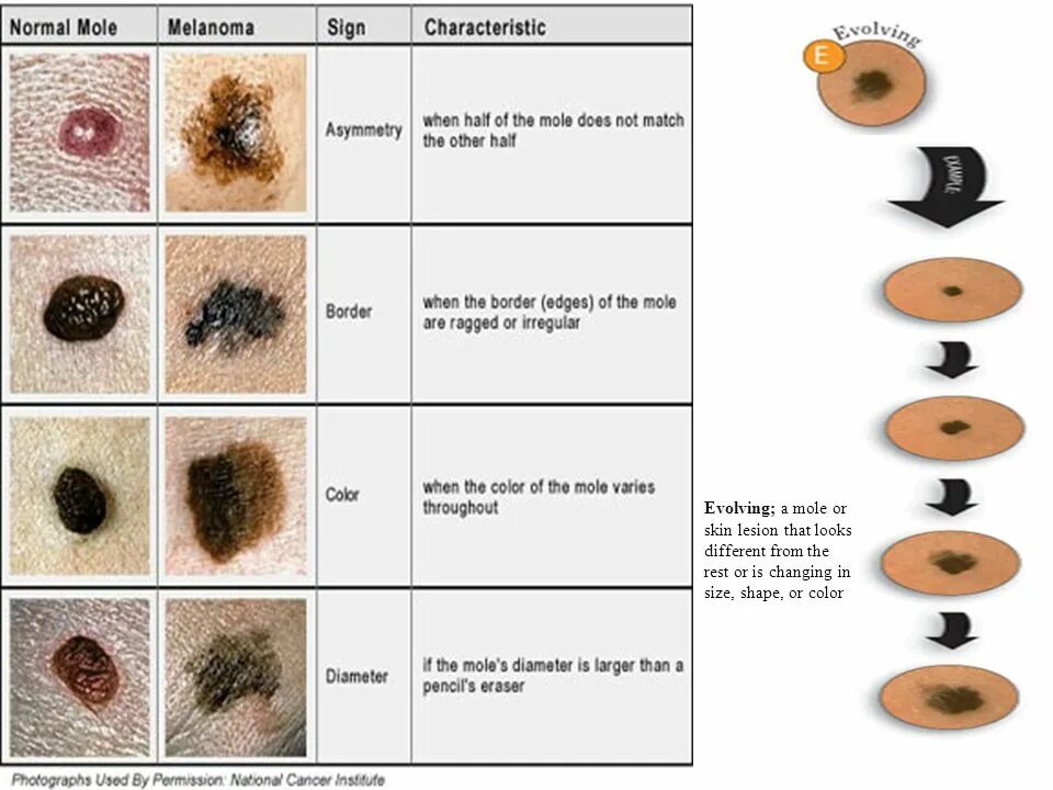 Последняя стадия меланомы фото MALIGNANT MELANOMA. Outline Introduction Aetiology Types Invasion and Metastasis