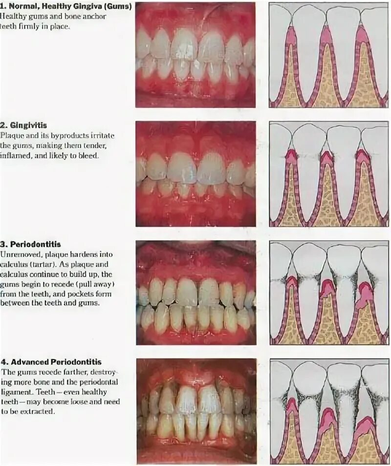 Последняя стадия пародонтоза фото Pin by Camille Kieboom on Dental in 2022 Dental hygiene school, Dental assistant