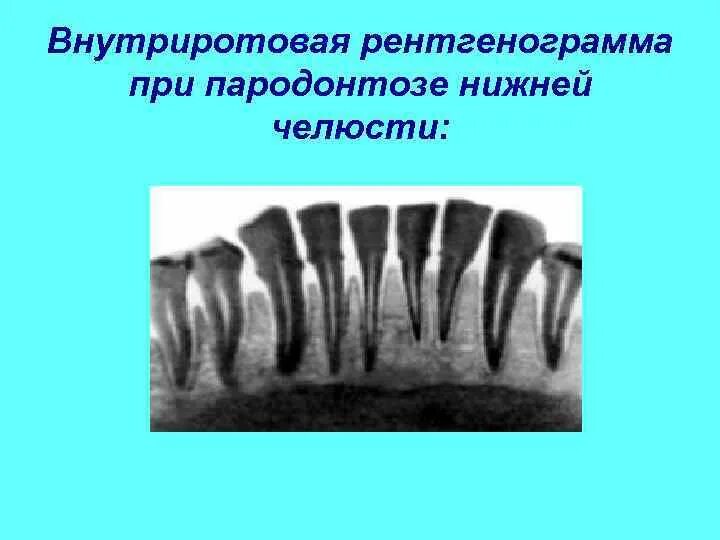 Последняя стадия пародонтоза фото Пародонтоз и идиопатические заболевания пародонта с прогрессирующим