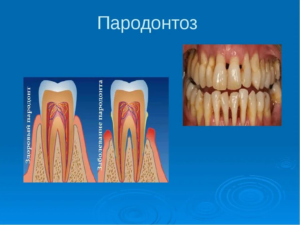 Последняя стадия пародонтоза фото Новости медицины