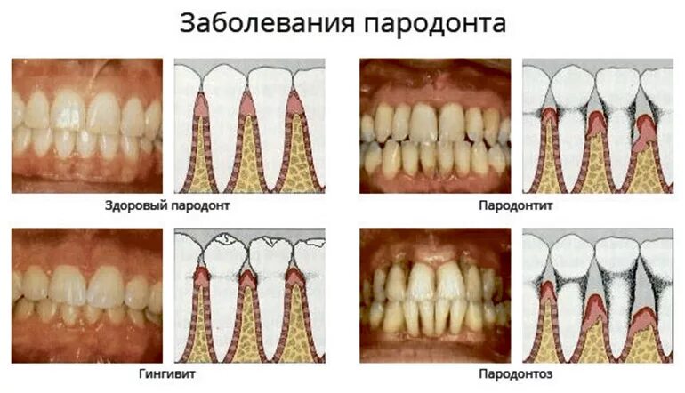 Последняя стадия пародонтоза фото Пародонтоз или пародонтит в полости рта