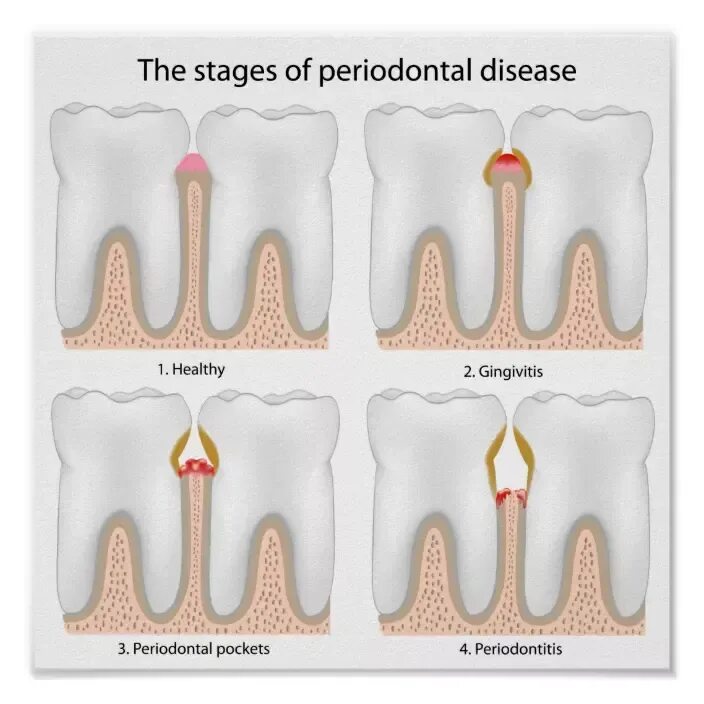 Последняя стадия пародонтоза фото Pin on Dental cosmetics