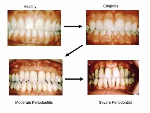 Последняя стадия пародонтоза фото Healthy to Severe Periodontitis