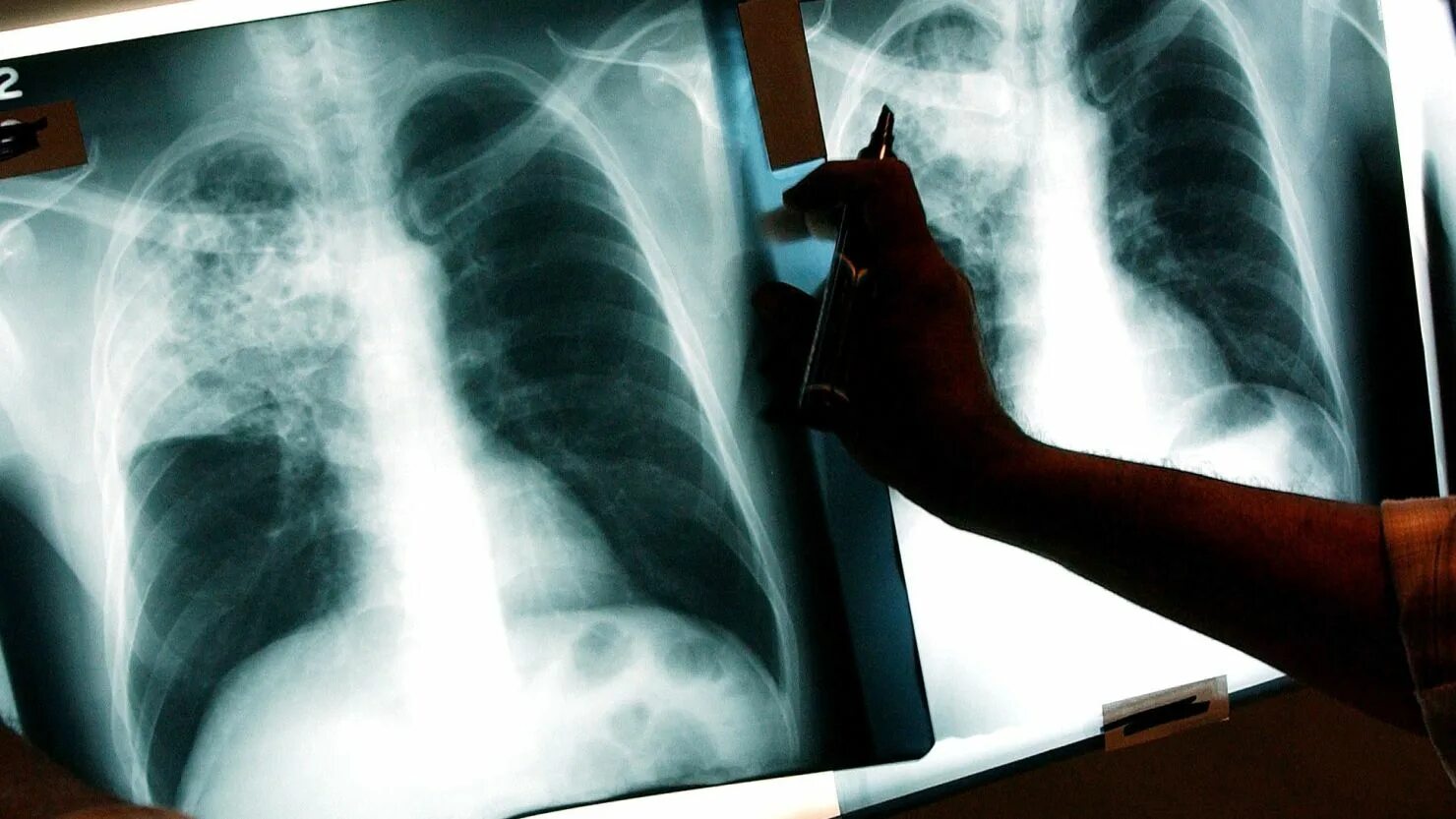 Последняя стадия туберкулеза фото US tuberculosis cases nearing pre-pandemic levels, CDC data shows CNN