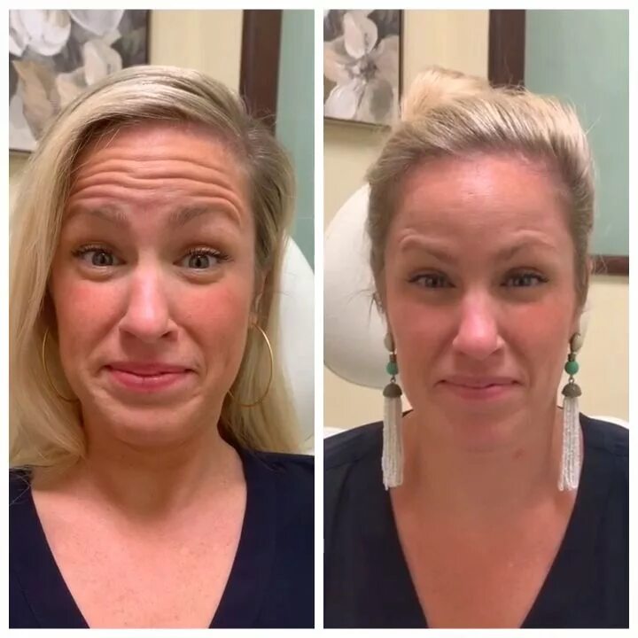 Последствия ботокса волос фото Botox Before & After Video Botox before and after, Botox face, Botox