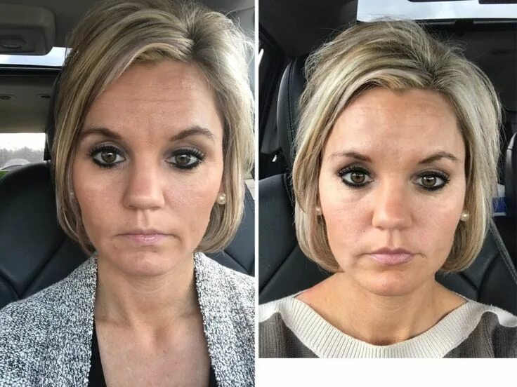 Последствия ботокса волос фото Botox & Fillers Before and After - A Cup Full of Sass Botox fillers, Forehead fi