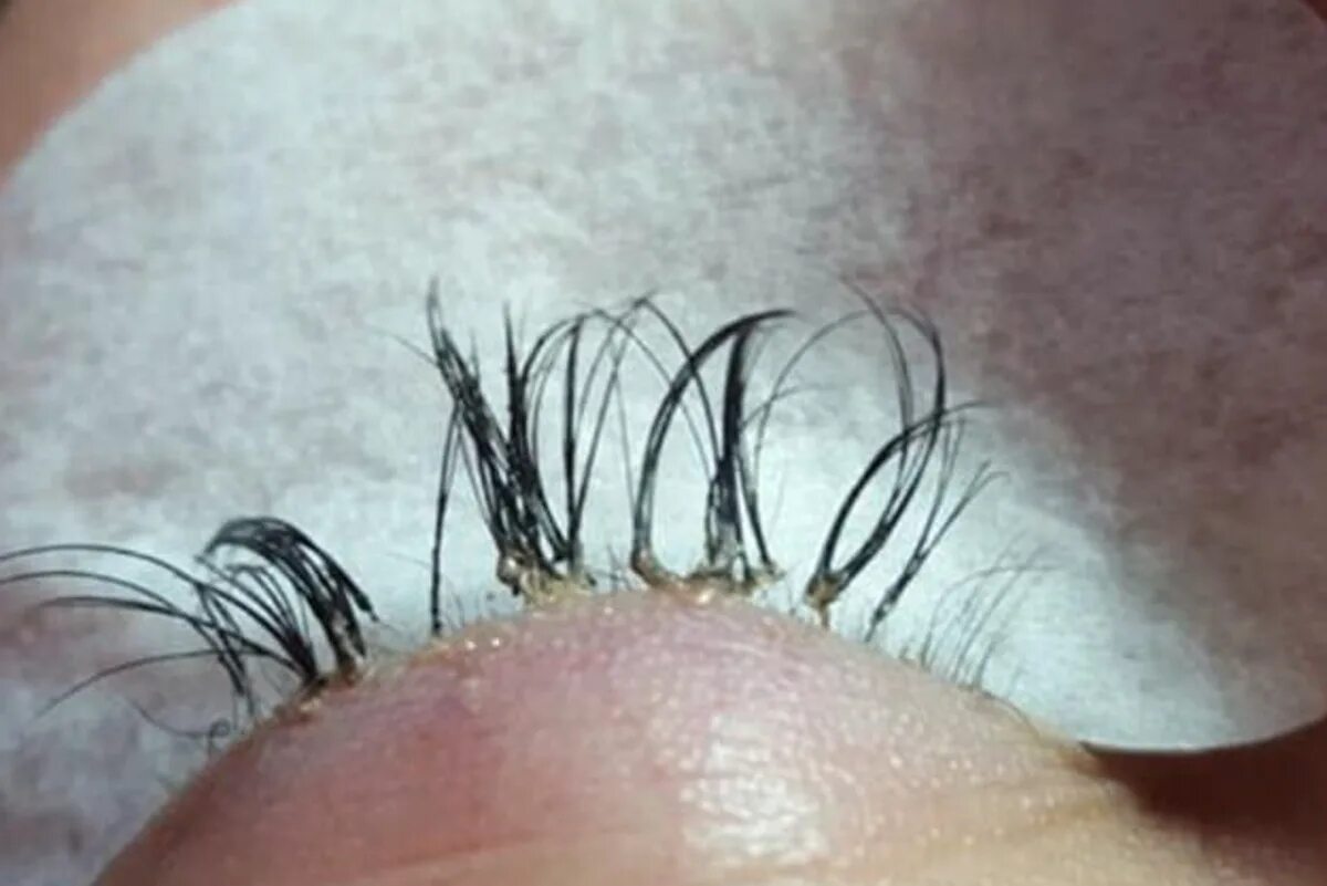 Последствия наращивания фото Beauty expert issues warning after woman’s eyelash extensions cause her real one