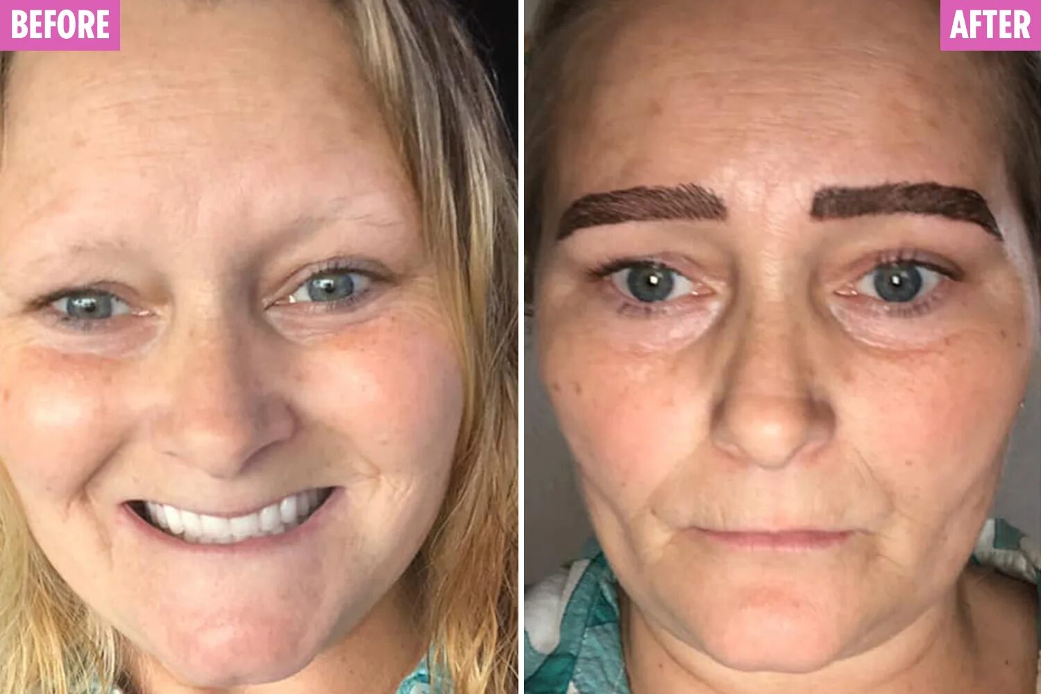 Последствия перманентного макияжа Microblading nightmare left me with weeping blisters and raw skin The Sun