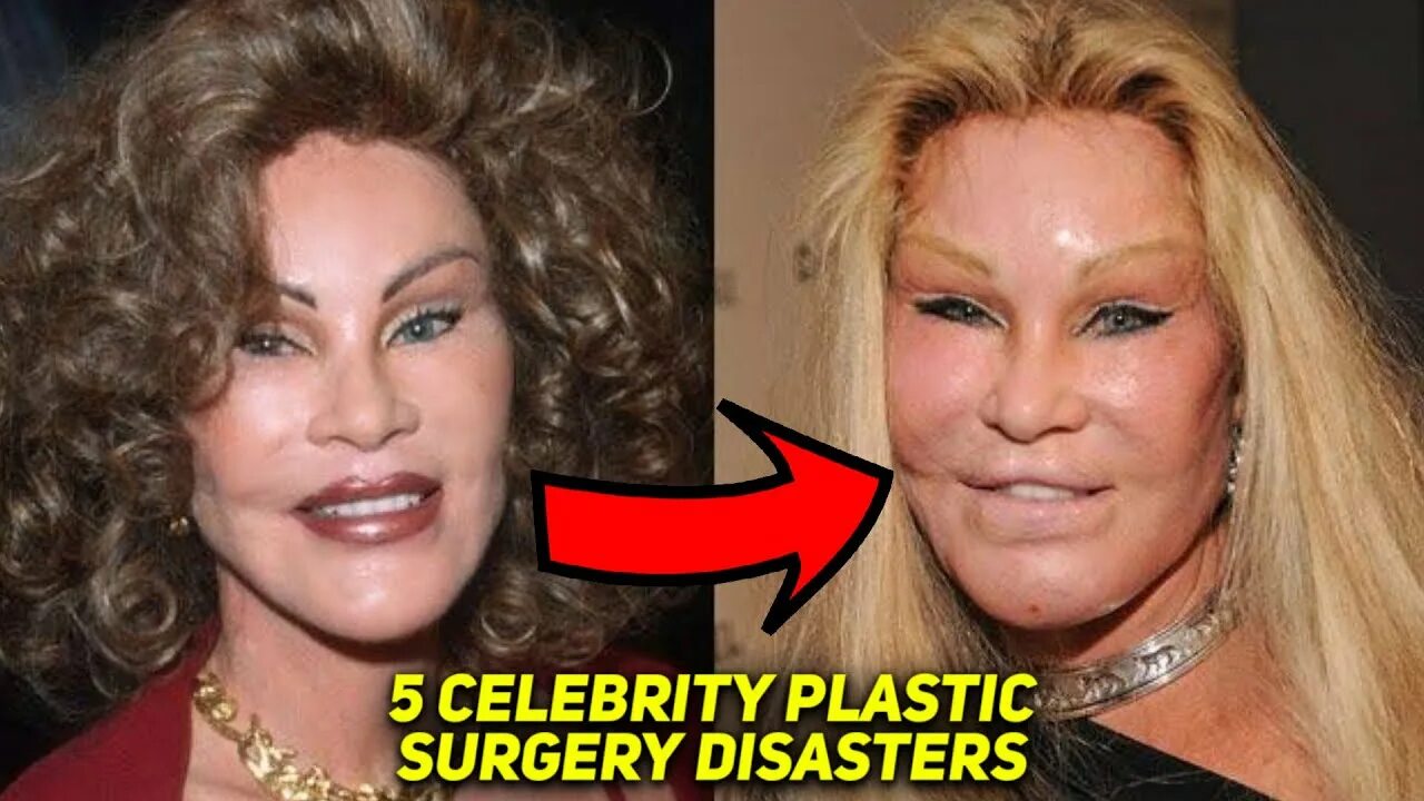 Последствия пластики фото 5 Celebrity Plastic Surgery Disasters - YouTube