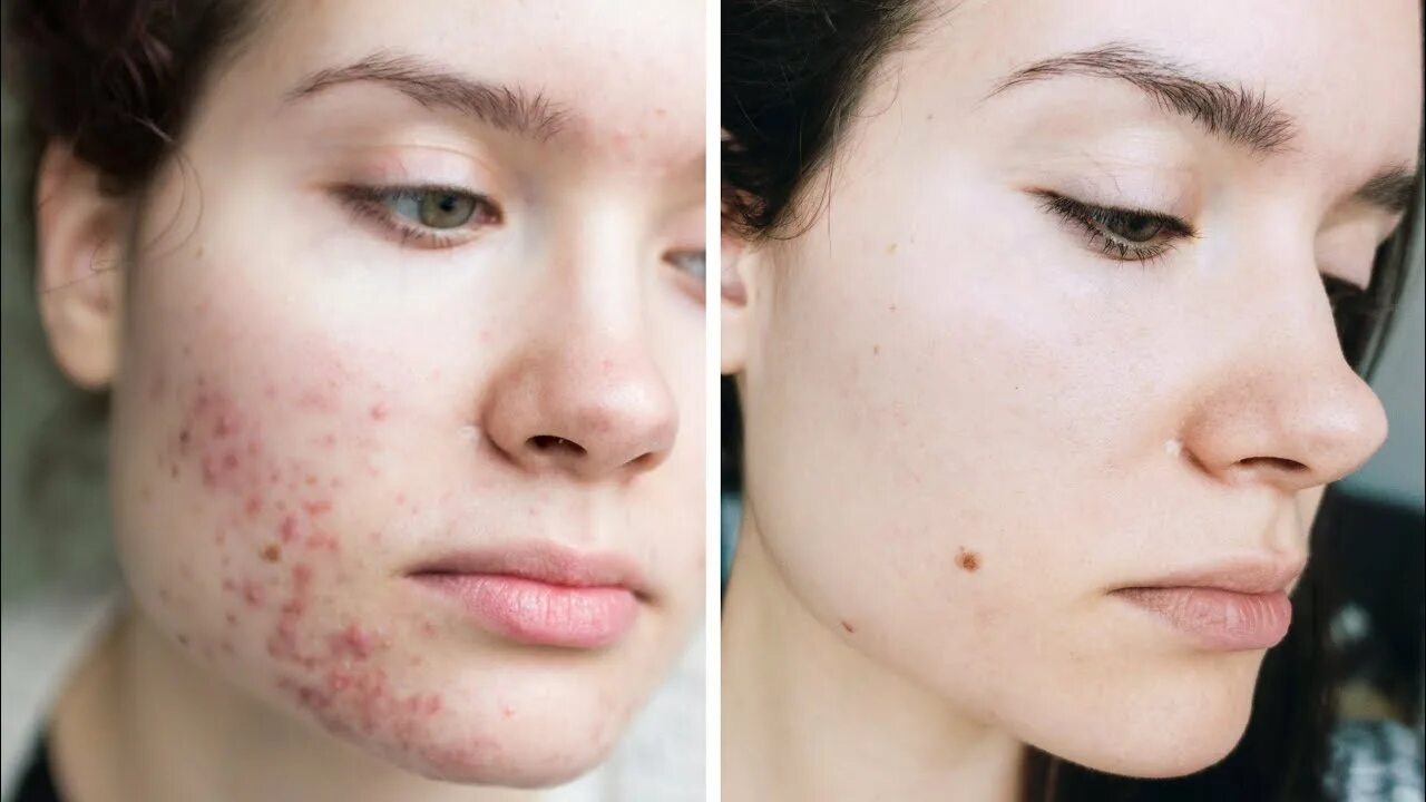 Последствия после прыщей на лице фото Acne Skincare + Overnight Tips & Tricks How To Stop Picking Pimples - YouTube