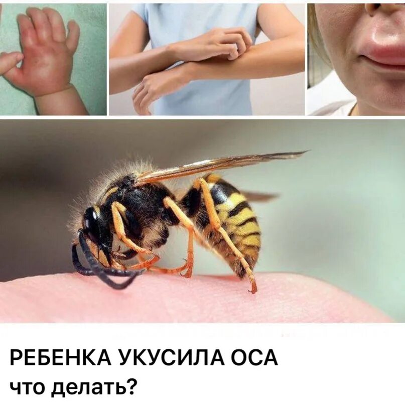 Последствия укуса осы фото Укус осы код: найдено 78 изображений