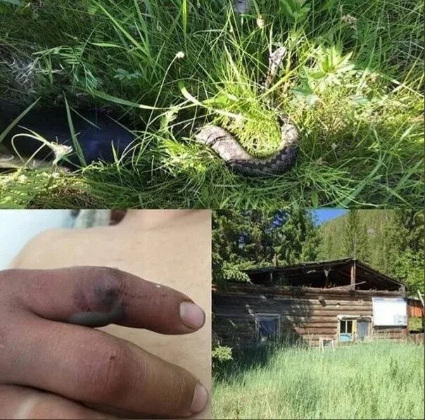 Последствия укуса змеи фото A woman who has been poisoned by a venomous snake Everything happened on the lak