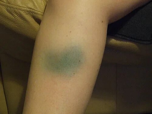 Последствия укусов фото Bruised leg This is the bruising that was caused by Janets. Flickr