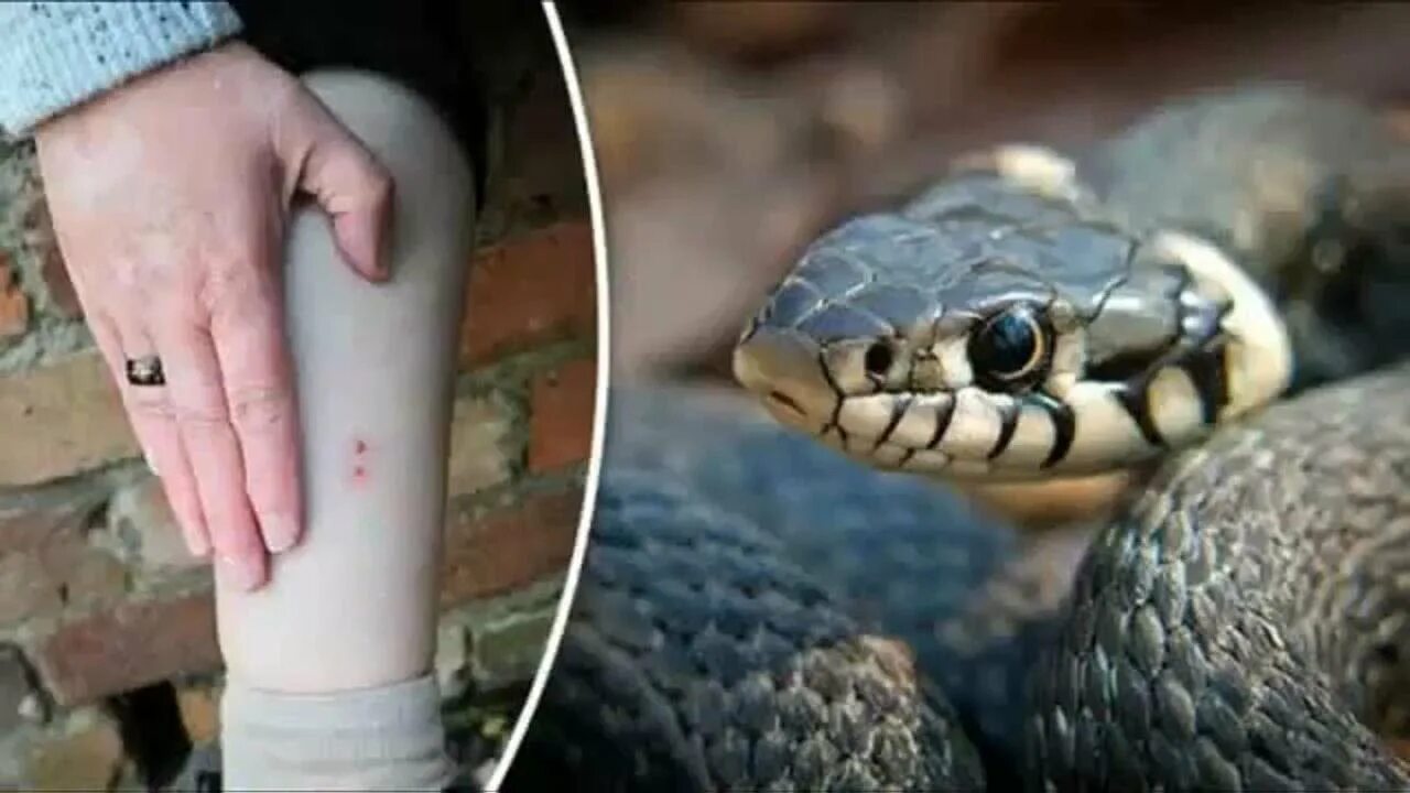 Последствия укусов змей фото Snake Bite First Aid Treatment - What to Do if Bitten by a Snake - YouTube