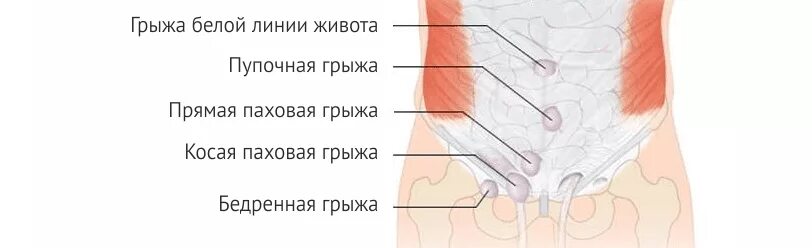 Послеоперационные фото грыжи белой линии живота Грыжа белой линии живота - причины, лечение, операция, удаление