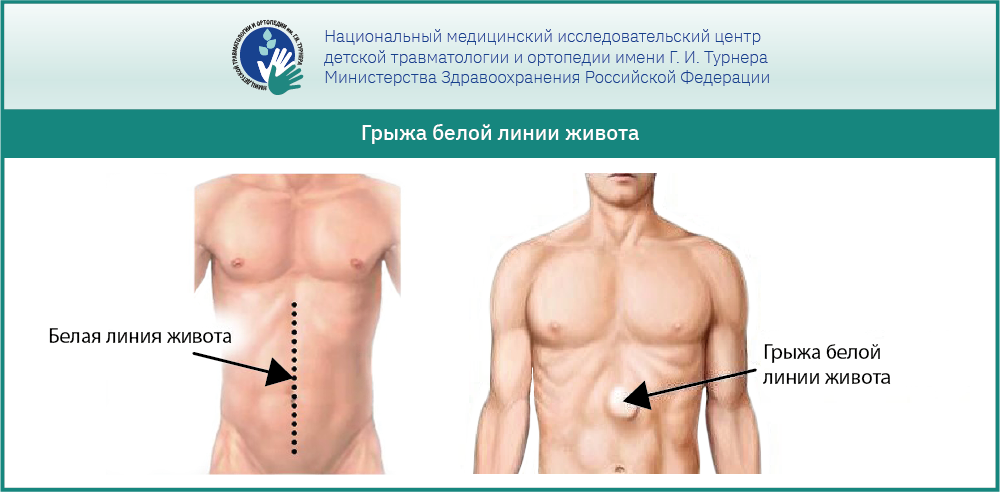 Послеоперационные фото грыжи белой линии живота Грыжа белой линии живота у ребенка: основные аспекты, рекомендации врачей и мето