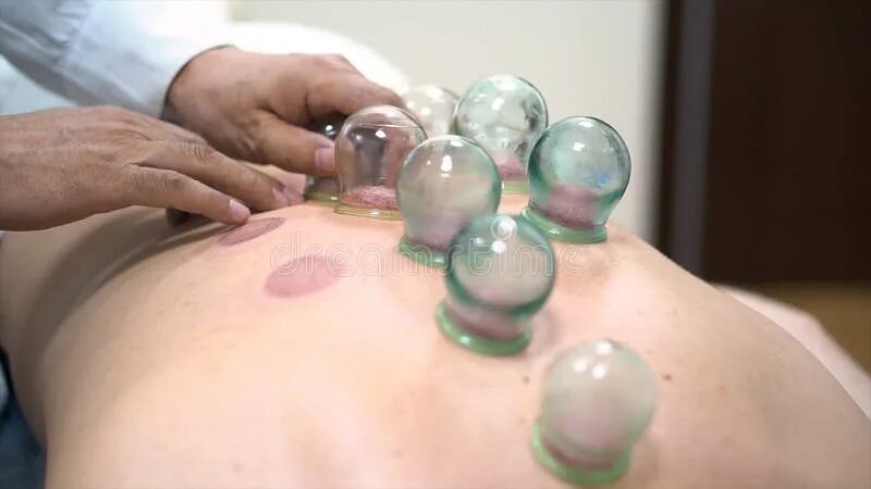 Поставить банки фото Close Up for Multiple Vacuum Cups, Medical Cupping Therapy on Human Body, Wellne