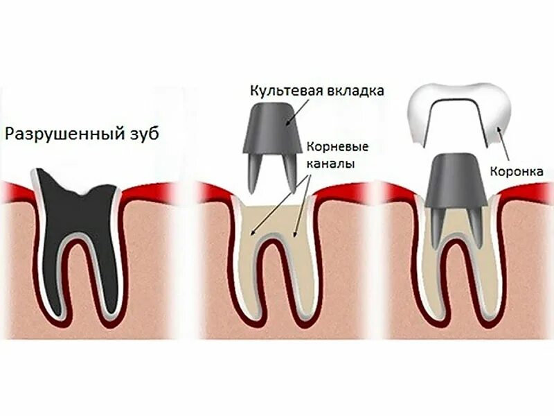 Поставить коронку на зуб фото Культевые вкладки на зубы - Сити Дент