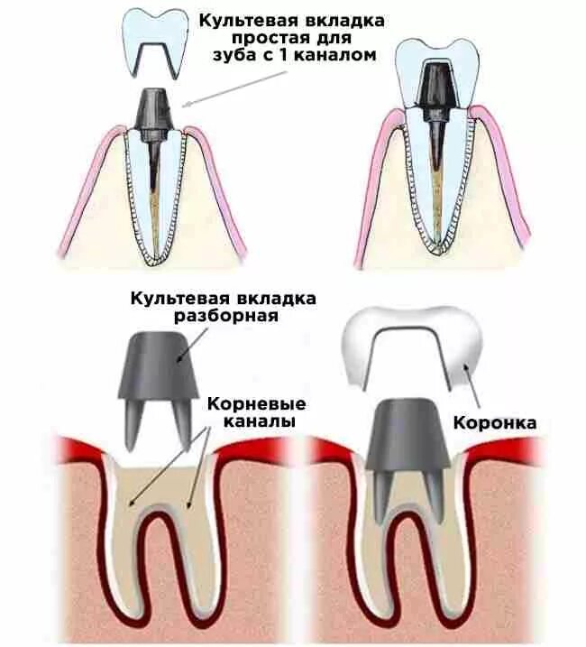 Поставить коронку на зуб фото Культевая вкладка на зуб по доступным ценам в Москве. Восстановление зуба культе