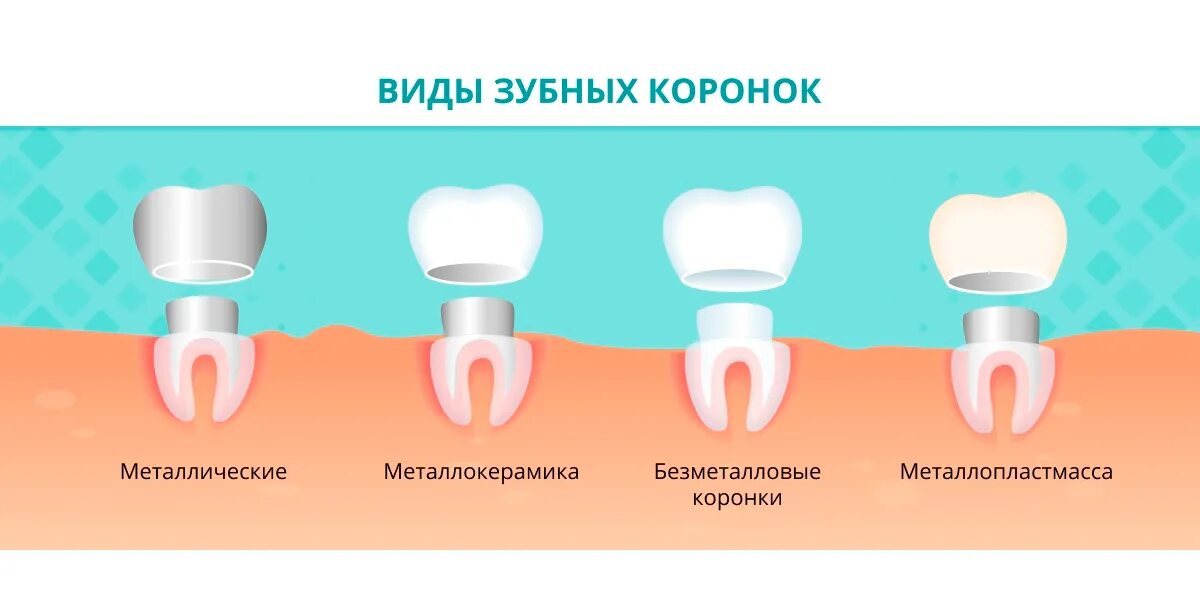 Поставить коронку на зуб фото Замена коронок