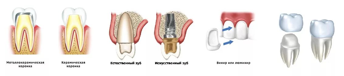 Поставить коронку на зуб фото Зубные протезы и коронки в Калининграде и доступная цена - Ортодонт в Калинингра