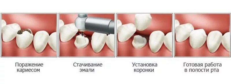 Поставить коронку на зуб фото Металлокерамическая коронка на зубы, виды, плюсы и минусы, показания к установке