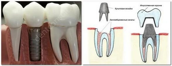 Поставить коронку на зуб фото Протезирование при отсутствии зубов верхней челюсти в СПб