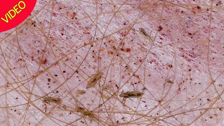 Постельные вши фото укусов на теле человека Health experts issue head lice warning as kids go back to school - Irish Mirror 