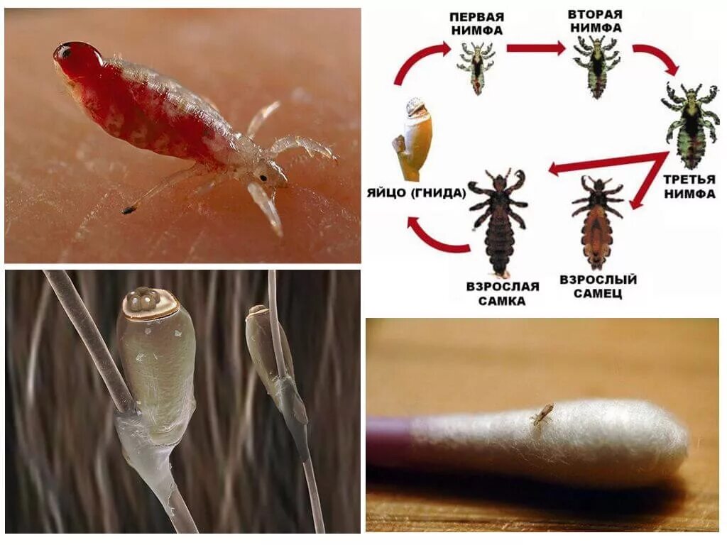 Постельные вши укусы фото симптомы Укусы вшей на теле и голове человека, фото