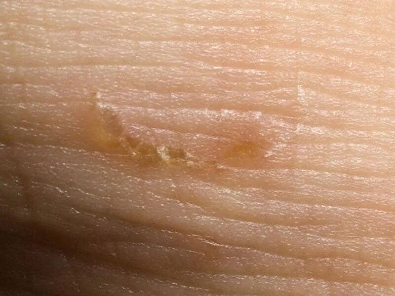 Постскабиозный дерматит после чесотки фото Scabies Stratum Dermatology Clinics