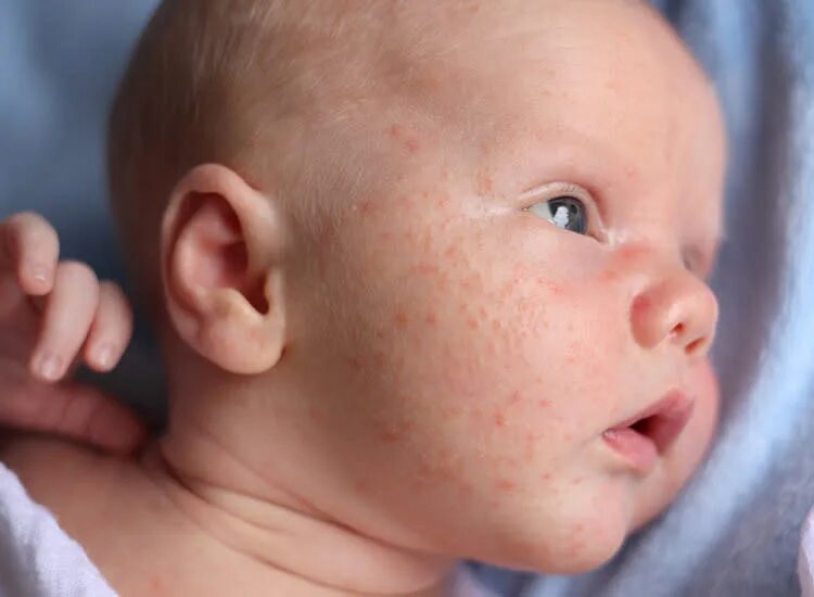 Поствирусная сыпь у ребенка фото Baby Rashes: Types, Symptoms & More