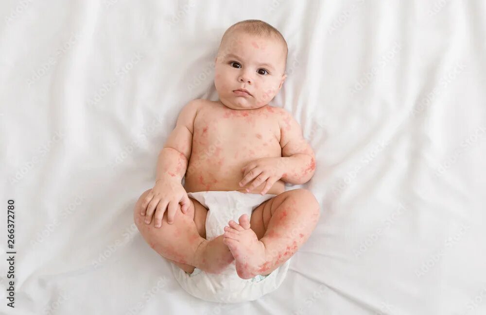 Потница фото симптомы и лечение Upset newborn baby suffering from measles rash фотография Stock Adobe Stock