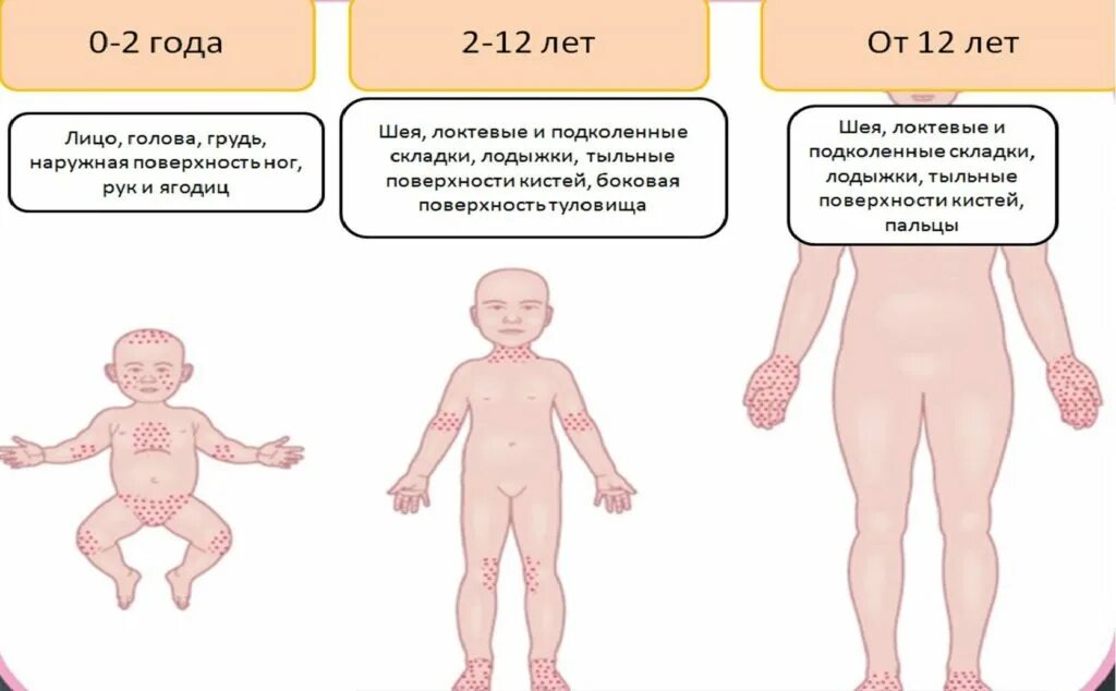 Потница у детей фото симптомы и лечение Аллергический дерматит у детей: фото, признаки и лечение