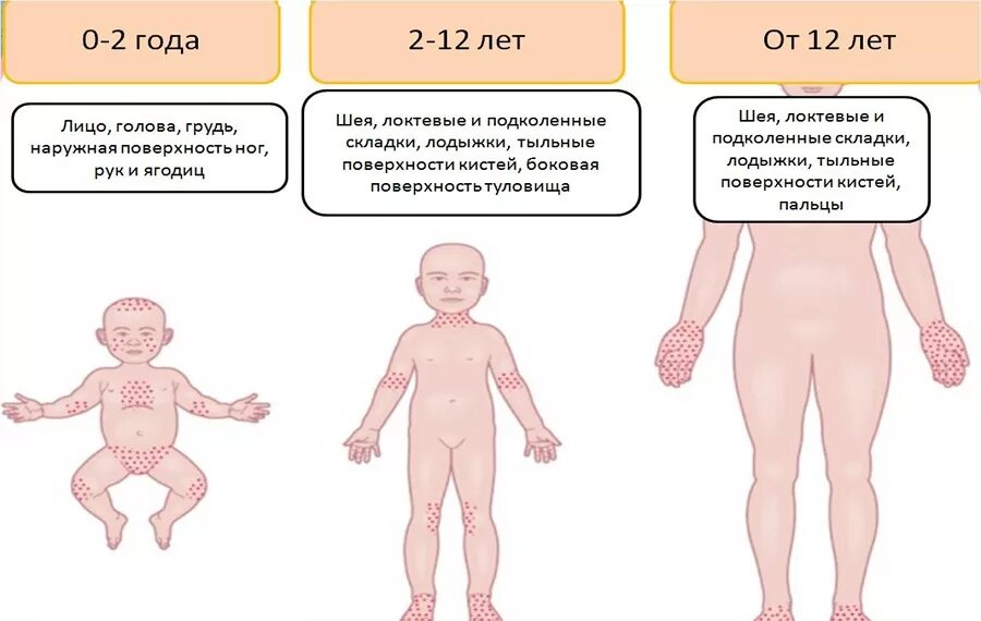 Потница у взрослого фото симптомы Как отличить потницу от аллергии у грудничка: 13 отличий, симптомы, советы по ух