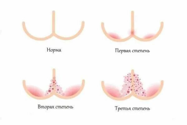 Потница у взрослого фото симптомы Пеленочный дерматит: причины, симптомы и лечение в статье аллерголога Столярова 