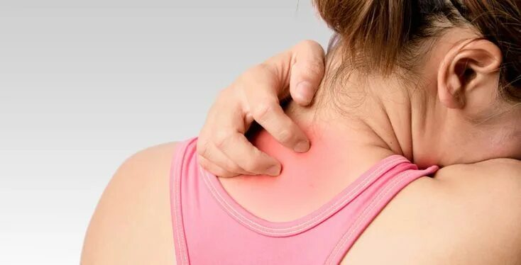 Потница у взрослого фото симптомы и лечение How to Get Rid of Heat Rash: 19 Fast Home Remedies Heat rash, Rashes remedies, S