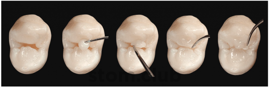 Поверхности зуба фото Dental Colibri, стоматологическая клиника, ул. 45-я Параллель, 20, Ставрополь - 