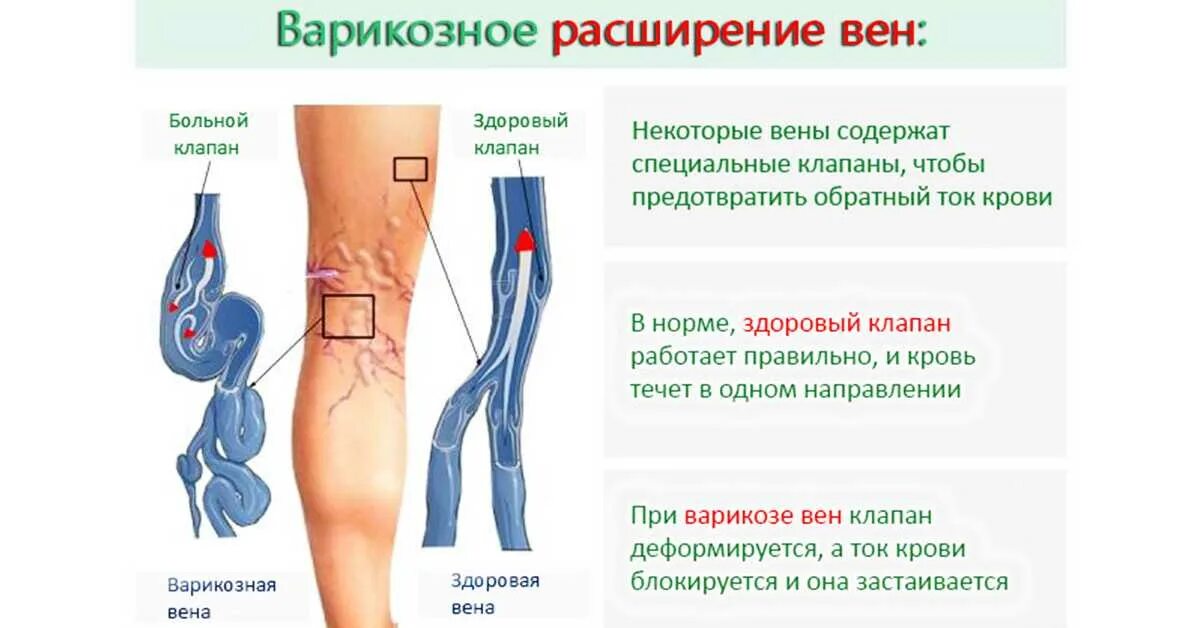 Поверхностный тромбофлебит нижних конечностей фото Почему прячутся вены: найдено 30 изображений